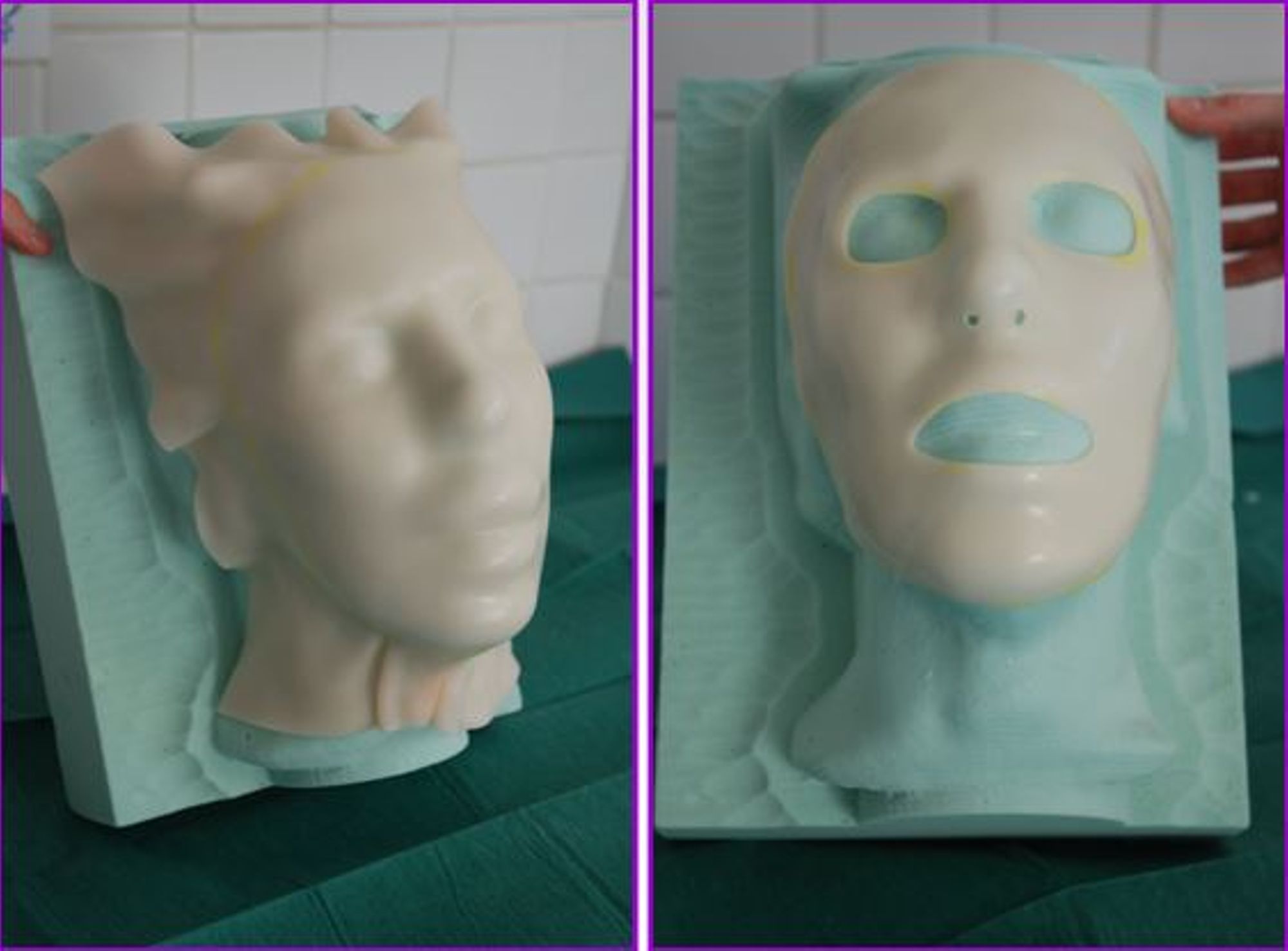 Réhabilitation Brûlés et Locomoteur